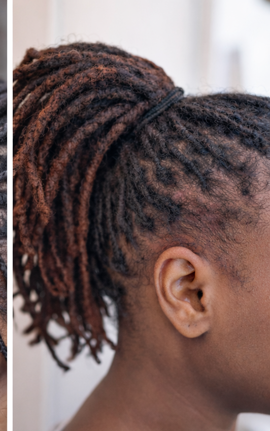 Tightly retwisted locs pulling at the scalp