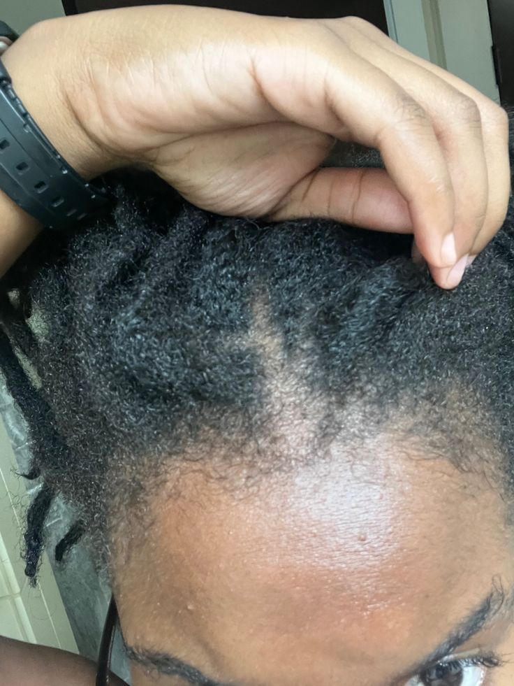 Your Scalp Is Constantly Irritated