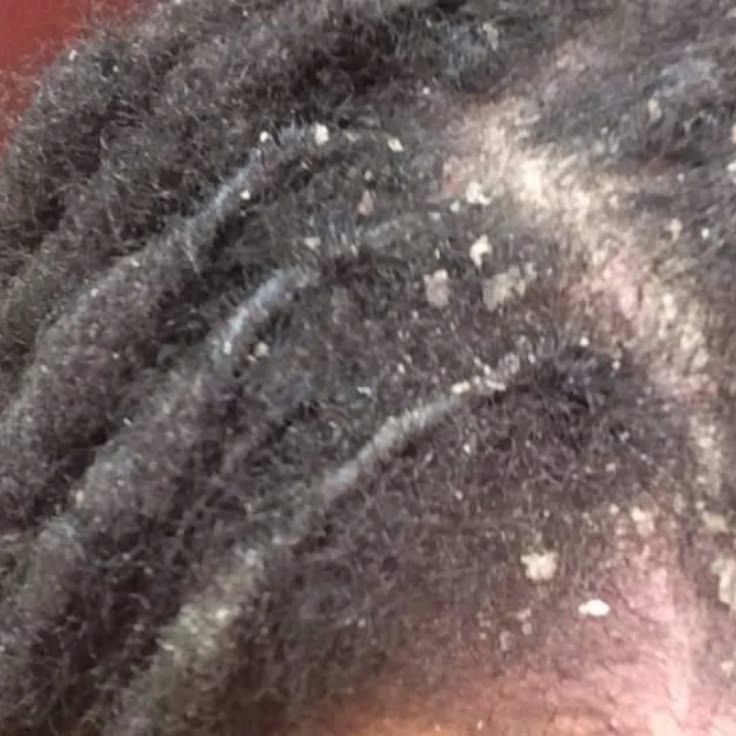Do Not Ignore an Itchy Scalp